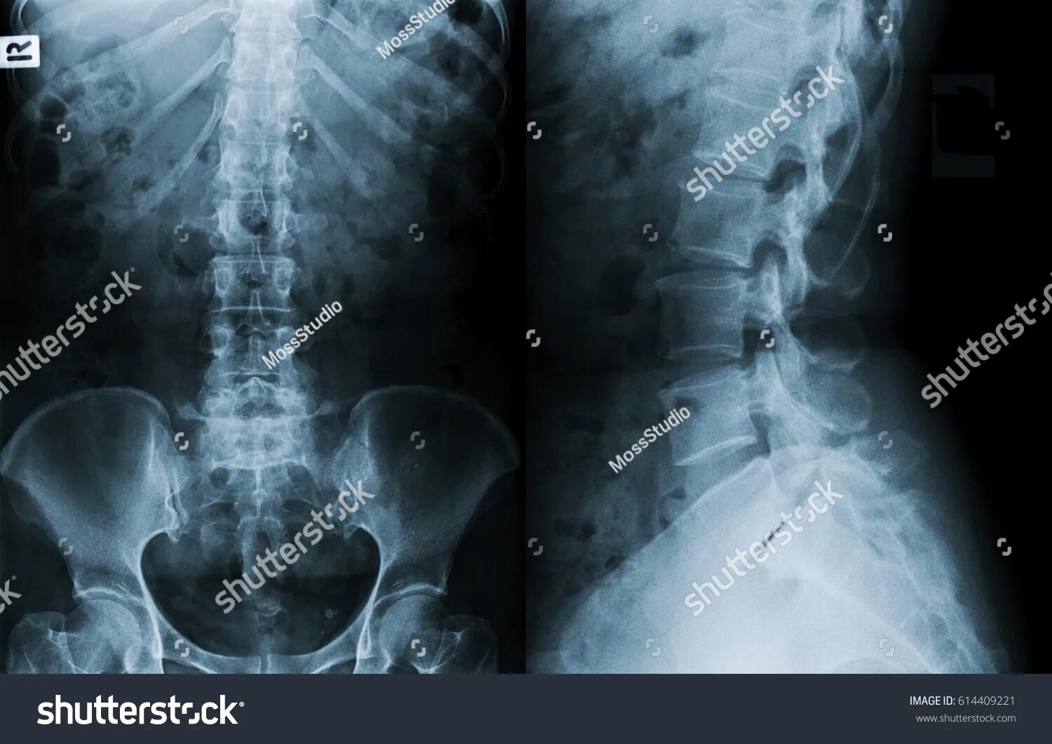 Рентген поясничного отдела как делают женщинам фото 1 250 рез. по запросу "Lateral spine xrays" - изображения, стоковые фотографии, 