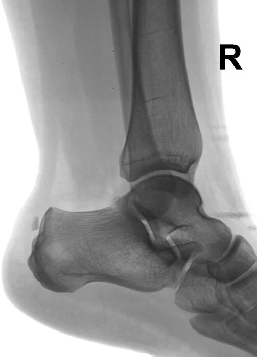 Рентген пяточной кости норма фото Боли в области пятки. Направлен на рентгенографию пяточной кости. Портал радиоло