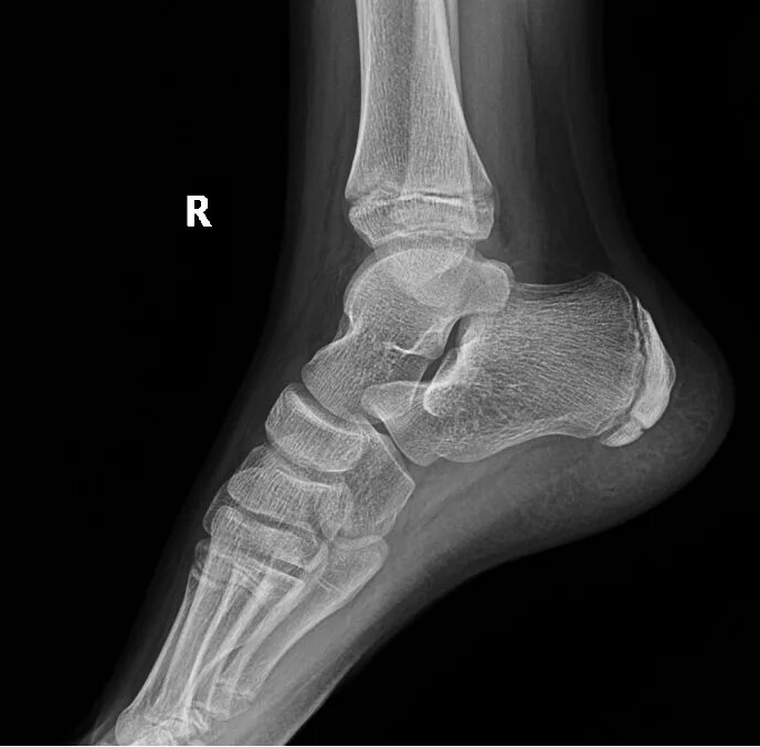 Рентген пяточной кости норма фото Клинические случаи рентгенологического отделения - НЦЗД