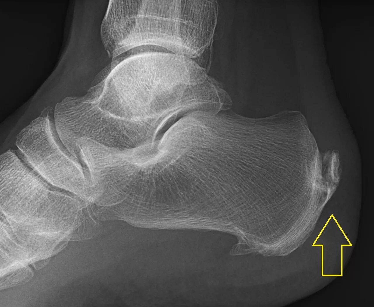 Рентген пяточной кости норма фото File:Achilles insertional calcific tendinosis (labeled).jpg - Wikipedia