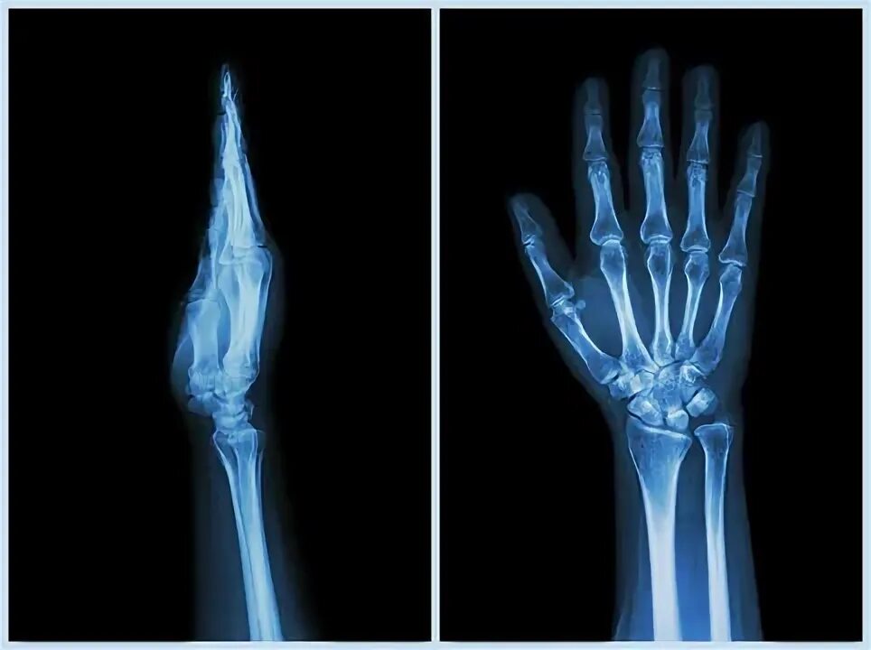 Рентген руки фото Hand X Ray Изображения: просматривайте стоковые фотографии, векторные изображени