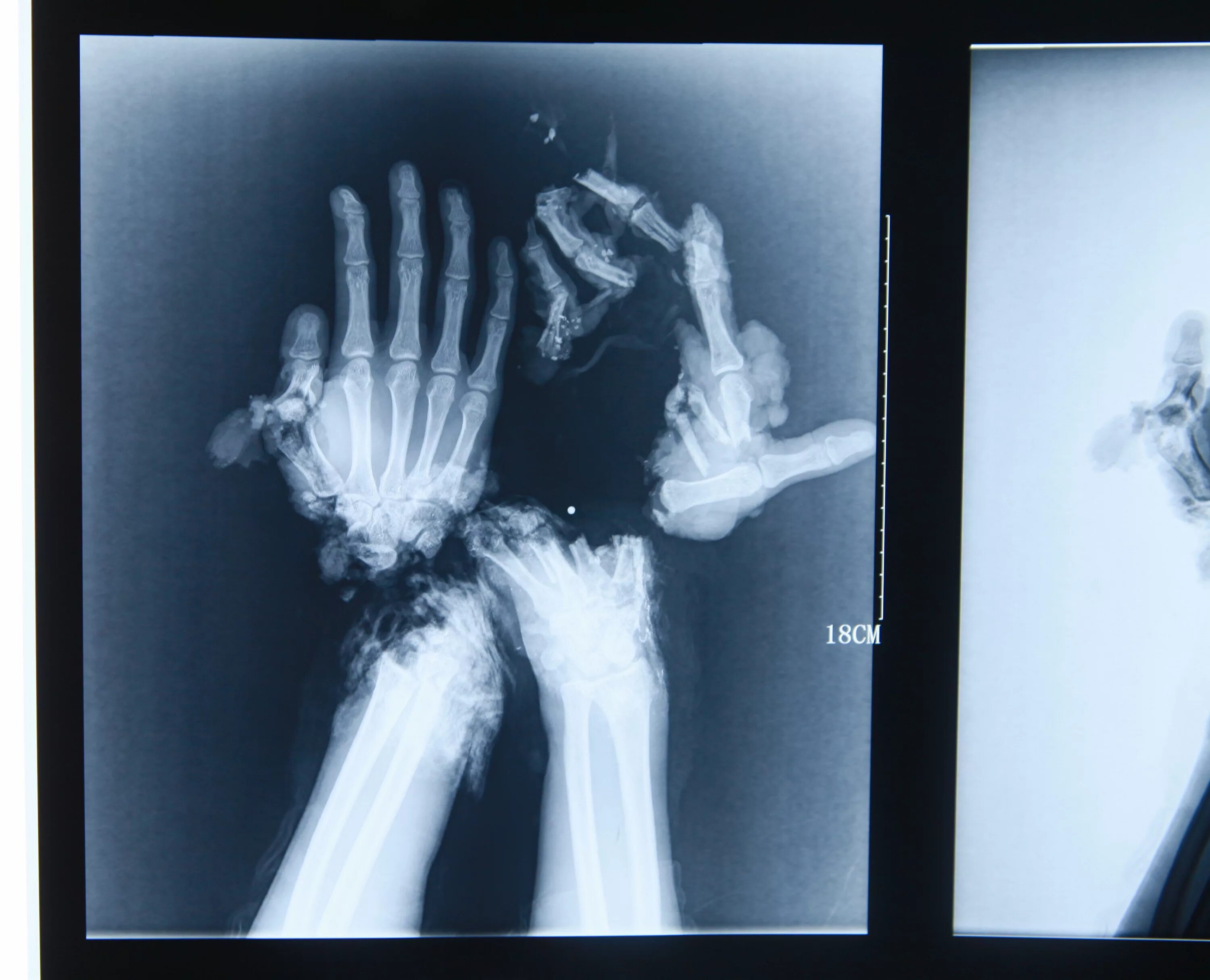 Рентген руки фото Wang Jin Gets 'Pincer Hands' Made From Fingers Reattached After Industrial Accid