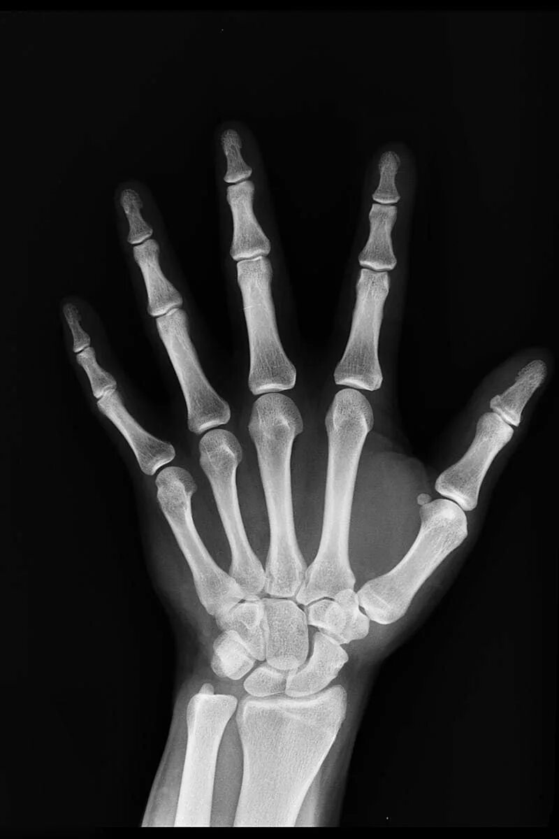 Рентген руки фото Hand X-ray Result Rontgenfoto's, Foto, Canvas schilderij