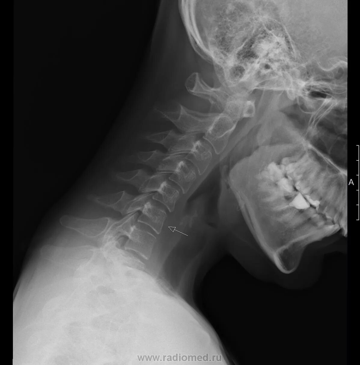 Рентген шейного отдела фото функциональный блок на уровне C6-7? Портал радиологов