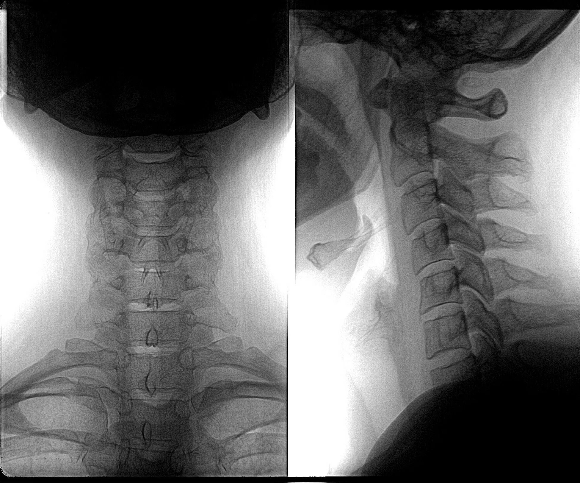 Рентген шейного отдела фото Рентген шейного отдела позвоночника - Olphoto.ru