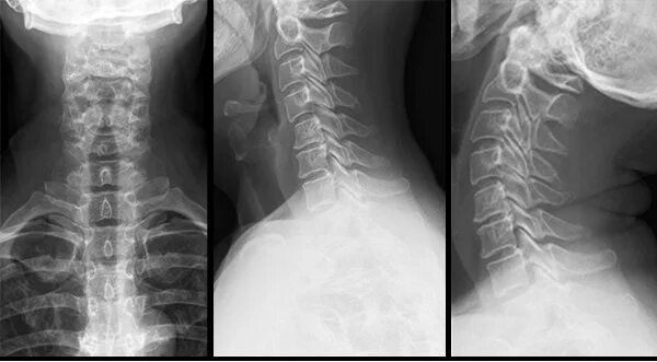 Рентген шейного отдела фото Профессиональный подбор ортопедических подушек и матрасов. - "Доктор Гален" конс