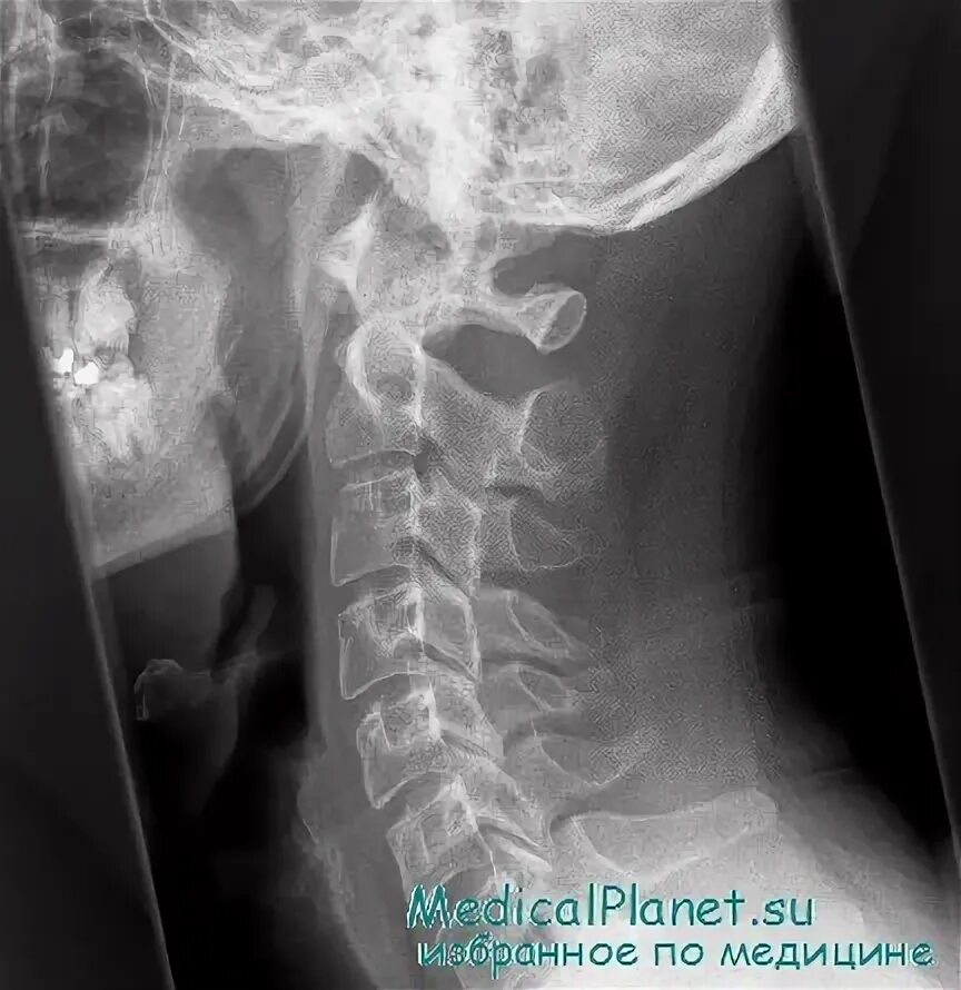 Рентген шейного отдела фото Рентгенография шейного отдела позвоночника у пациентов с травмой