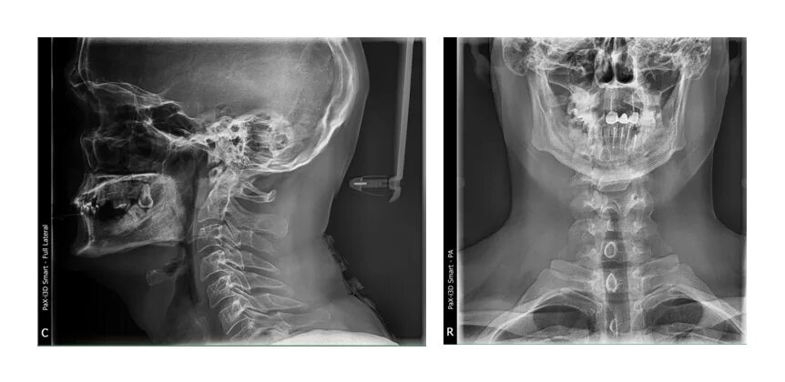 Рентген шейного отдела позвоночника фото Шейный отдел позвоночника через рот