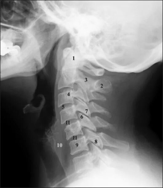 Рентген шейного отдела позвоночника фото ГЛАВА 2. ПОЗВОНОЧНИК