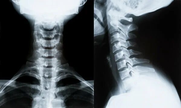 Рентген шейного отдела позвоночника фото Neck Xray Изображения: просматривайте стоковые фотографии, векторные изображения