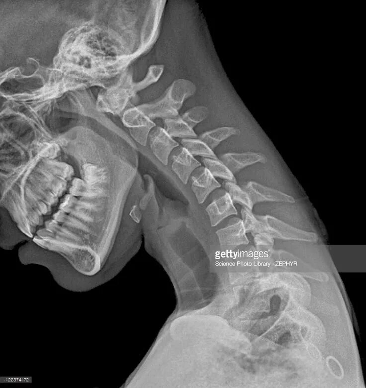 Рентген шейного отдела позвоночника фото Foto de stock : Normal flexed neck, X-ray Human body, Xray art, X ray