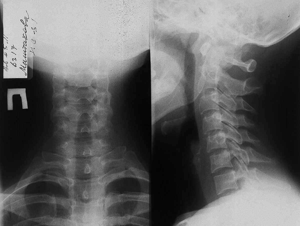 Рентген шейного отдела позвоночника фото Сделать рентген шейного отдела позвоночника