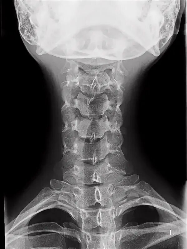 Рентген шейного отдела позвоночника фото Рентген шейного отдела позвоночника в Москве - сделать рентгенографию шейного от