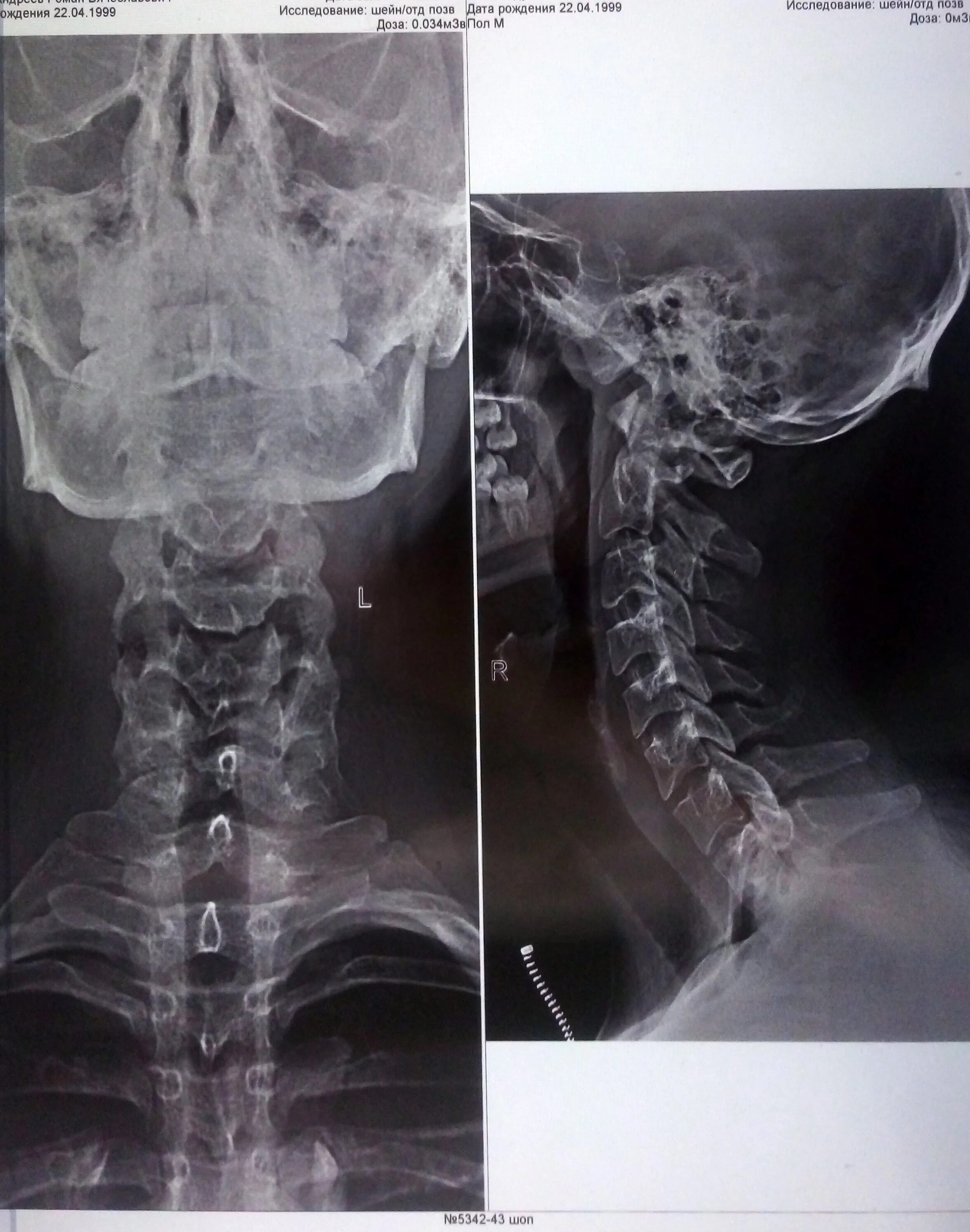 Рентген шейного отдела позвоночника фото Шейный отдел позвоночника. Описание снимка для призывной комиссии Портал радиоло