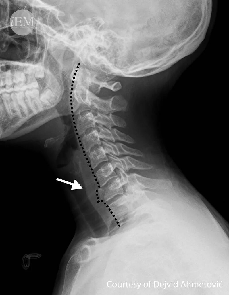 Рентген шейного отдела позвоночника фото 626.5 - Figure 5 - fracture of the body of C7. Figure 5: D. Flickr