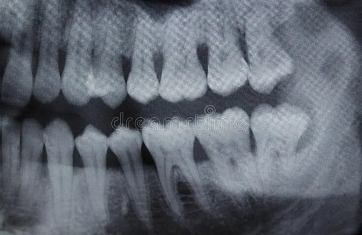 Рентген зубов фото как выглядит Dental Xray right half. Full mouth panoramic dental X-ray of a 29 year old male.