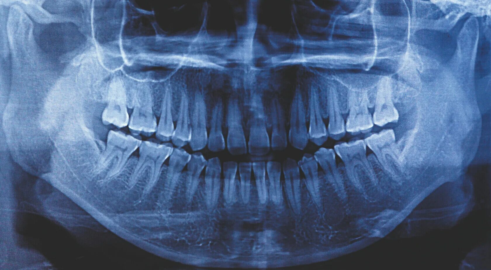 Рентген зубов фото как выглядит ОПТГ зубных рядов