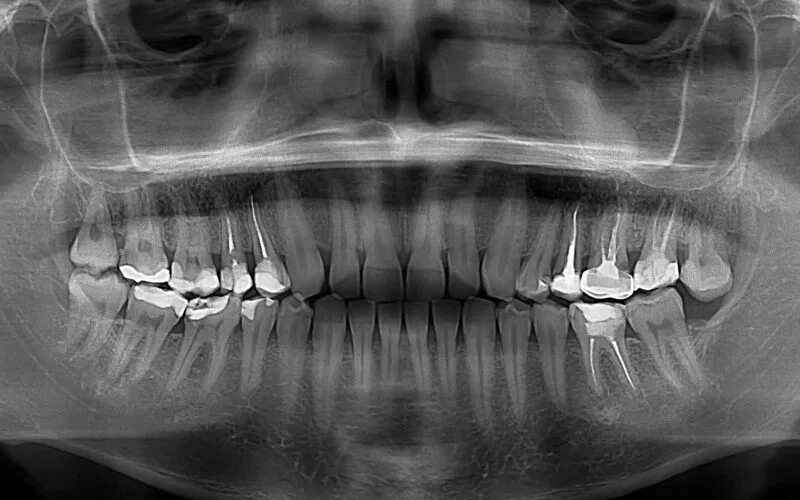 Рентген зубов фото как выглядит 3D диагностика зубов в стоматологии в Саратове ПрезидиумМед