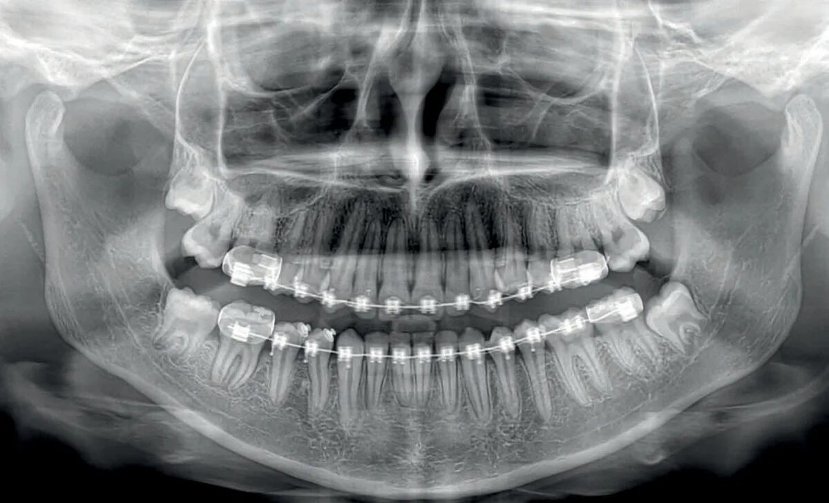Рентген зубов фото как выглядит В чем отличие панорамного и 3D снимка Стоматология ЭверестДент Дзен