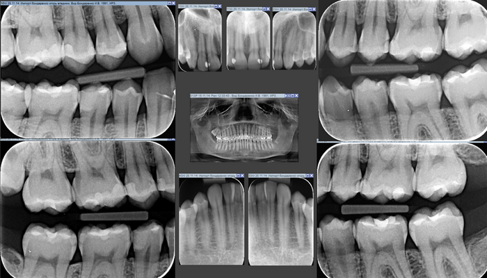 Рентген зубов фото как выглядит Рентгенограмма кариеса