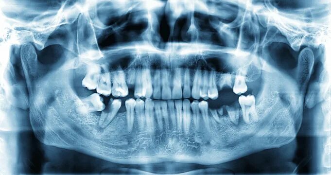 Рентген зубов фото как выглядит X-Ray Teeth Изображения: просматривайте стоковые фотографии, векторные изображен