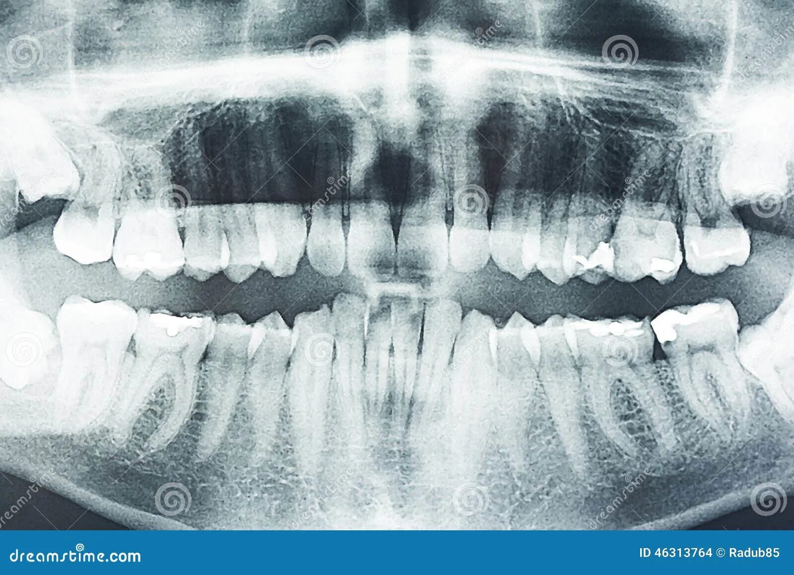 Рентген зубов фото как выглядит зубоврачебный панорамный луч X Стоковое Фото - изображение насчитывающей зубовра