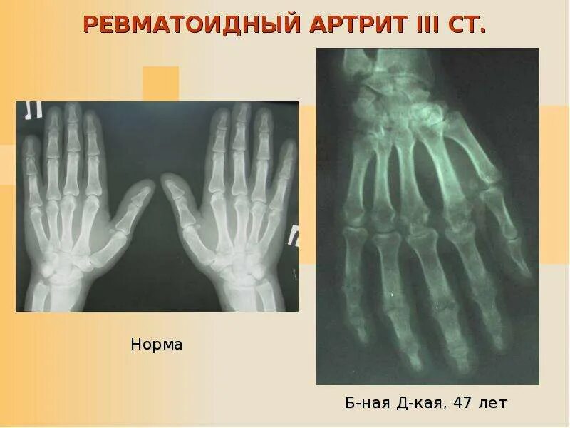 Ревматоидный артрит фото кистей начальная стадия Презентация на тему "РЕВМАТОИДНЫЙ АРТРИТ" - скачать презентации по Медицине - ск