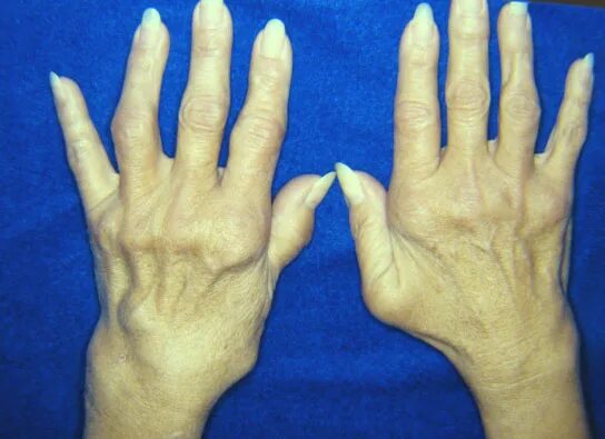 Ревматоидный артрит фото кистей начальная стадия rheumatoid arthritis hands