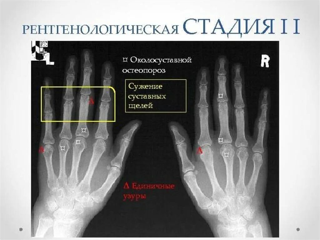 Ревматоидный артрит фото кистей начальная стадия Степени артроза кисти