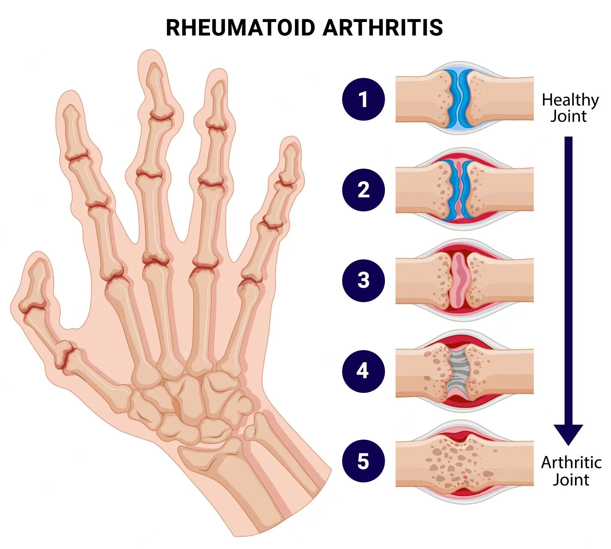 Ревматоидный артрит симптомы фото Rheumatoid Arthritis Physical Therapy in Manhattan & Brooklyn, NYC