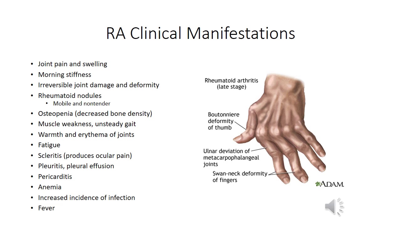 Ревматоидный артрит симптомы фото 3-3 Connective Tissue Disorders Combined - YouTube