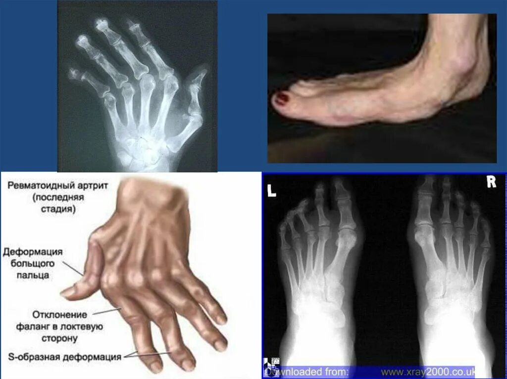 Ревматоидный артрит симптомы у женщин фото Ревматоидный артрит