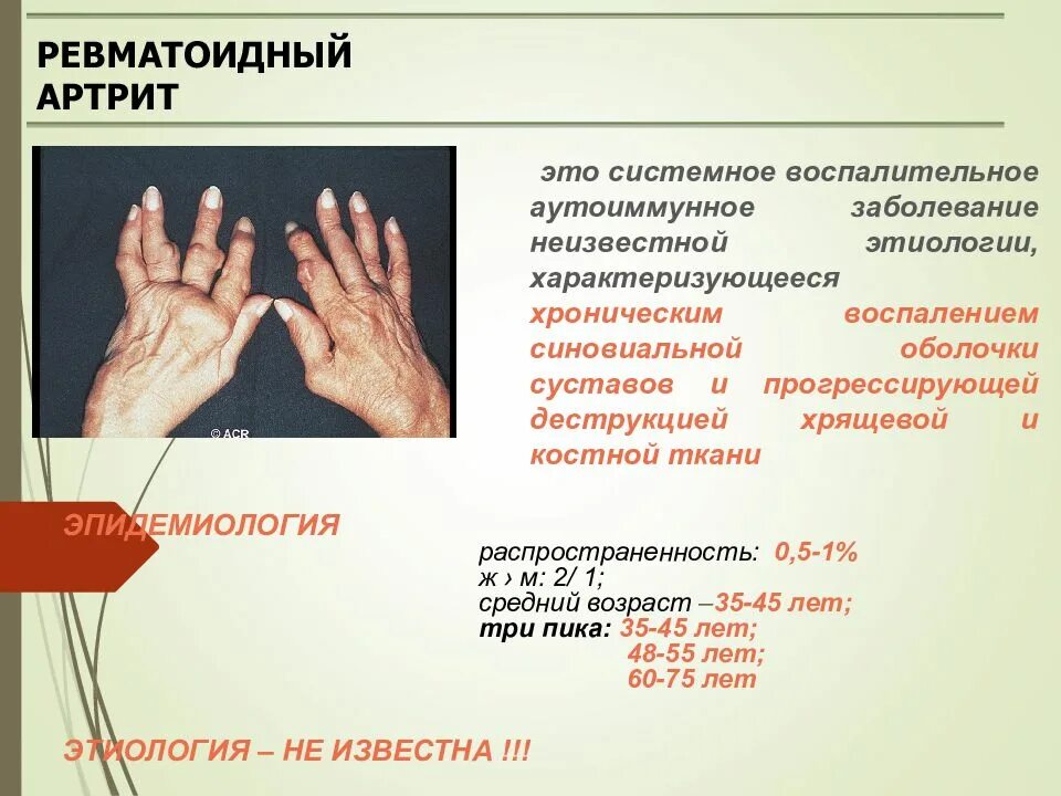 Ревматоидный артрит симптомы у женщин фото Ревматоидный артрит карта вызова