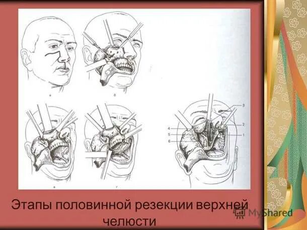 Резекция верхней челюсти фото Резекция челюсти: причины, поводы, способы проведения Медицинская Энциклопедия