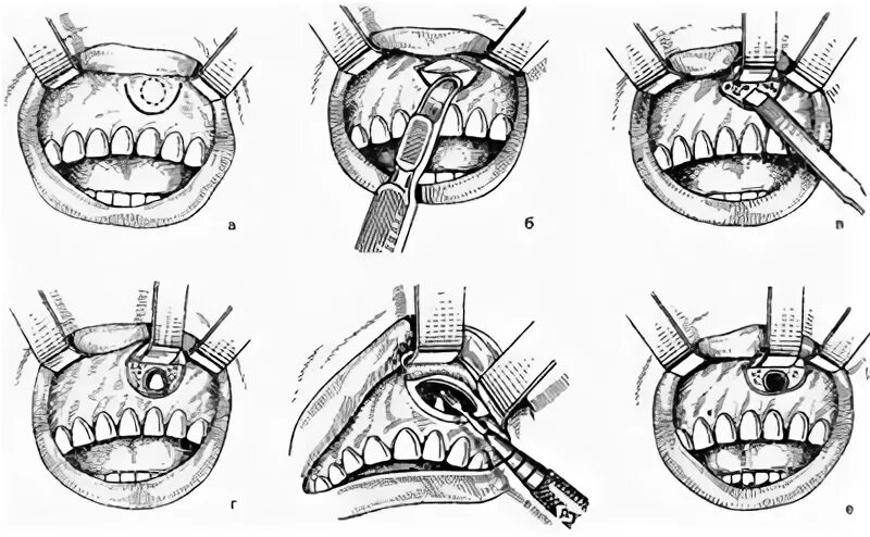 Резекция верхней челюсти фото Схема этапов операции резекции верхушки корня центрального верхнего резца - Опер