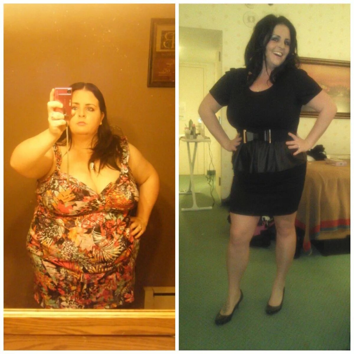 Pin on Bariatric Surgery and Amazing Weightloss