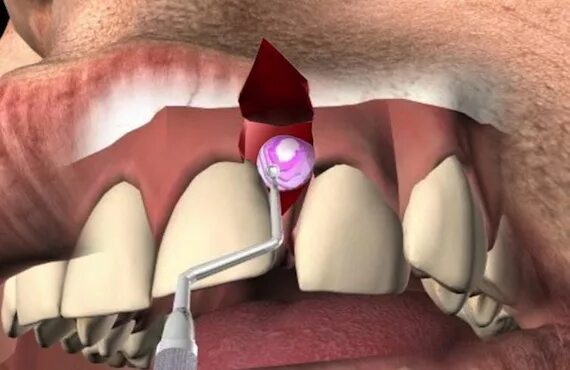Резекция зуба фото Цистоэктомия зуба по доступной цене