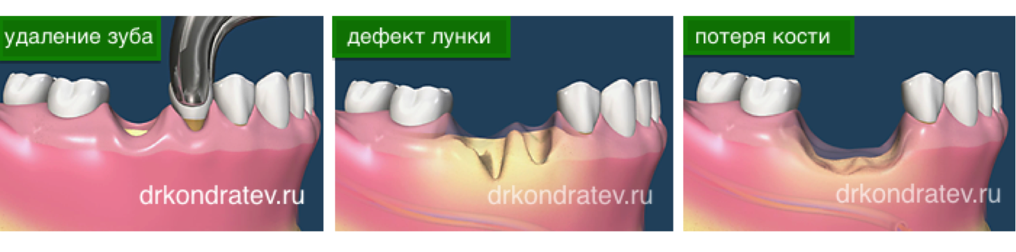 Резекция зуба фото Удаление костной ткани зуба