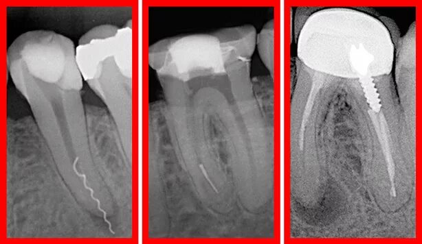 Резекция зуба фото Эндодонтия в стоматологии "DentalPRO"! Современная эндодонтия по доступной цене 