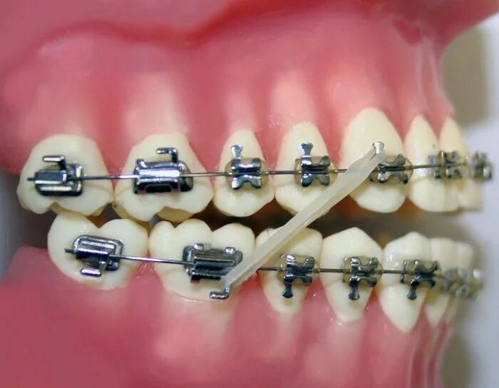 Резинки на зубах фото Rubber Bands For Teeth Braces Teeth braces, Braces, Braces elastics