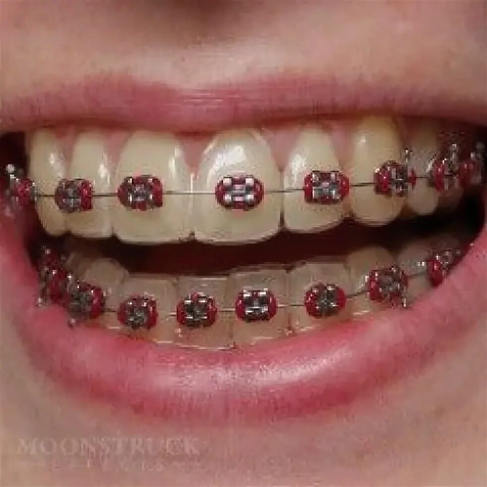 Резинки на зубах фото Anwen - Fake Braces Teeth - Red Braces Color #braces #fake #braces Brace 歯 列 矯 正