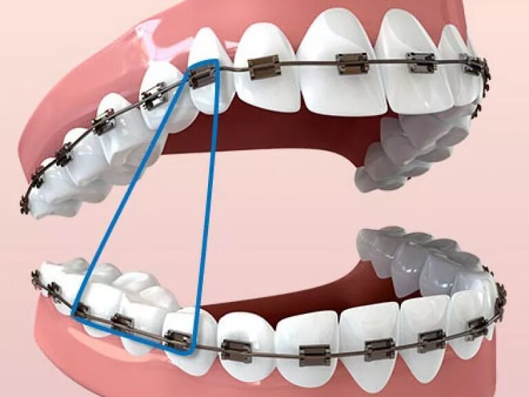 Резинки на зубах фото Межчелюстные тяги