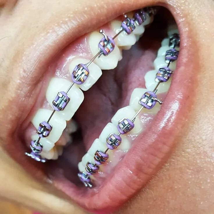 Резинки на зубах фото Pin on Braces Braces colors, Cute braces, Metal braces