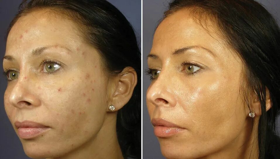 Результаты мезотерапии лица фото до и после ViPeel Chemical Skin Peel Orange County - Irvine, CA - Dr. Nissan Pilest Skin tr